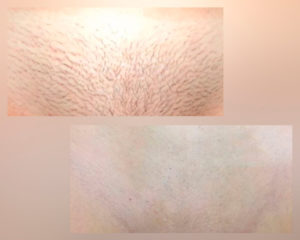 фото до и после процедуры элос-эпиляции зоны бикини