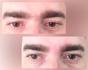 фото до и после процедуры элос-эпиляции бровей