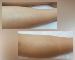 фото до и после процедуры элос-эпиляции голеней