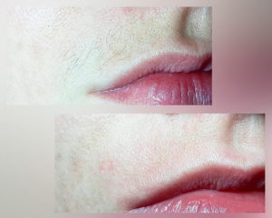 фото до и после процедуры элос-эпиляции зоны над верхней губой